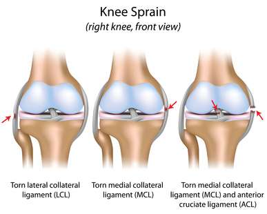 Knee Sprain 